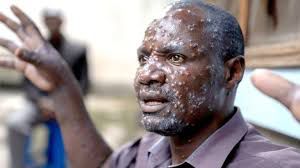 Mpox in Ghana: What to know about the stubborn virus giving health experts tough time