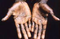 Ghana records its first monkey pox death, 23 confirmed active cases