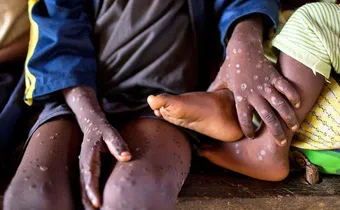 Mpox