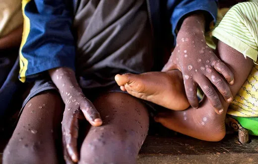 Mpox