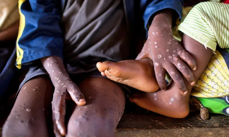 Mpox