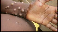 Monkeypox is a rare disease caused by monkeypox virus [WHO]