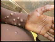 Monkeypox is a rare disease caused by monkeypox virus [WHO]