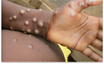 Monkey pox is a rare disease caused by monkeypox virus [WHO]