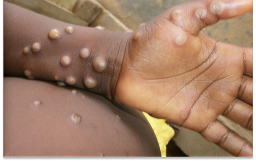 Monkey pox is a rare disease caused by monkeypox virus [WHO]