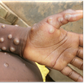 Monkey pox is a rare disease caused by monkeypox virus [WHO]