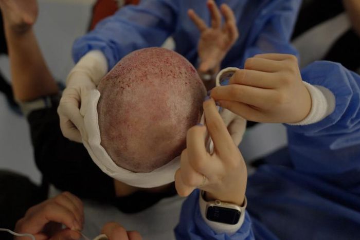 Spencer Macnaughton during his hair transplant in Istanbul TurkeyKenny Wassus/Business Insider
