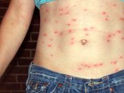 Skin rash