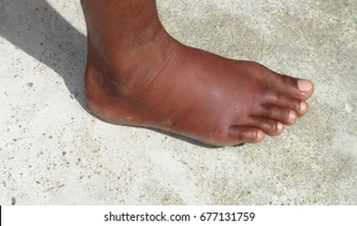 Exercises that reduce leg swelling [shuttershock]