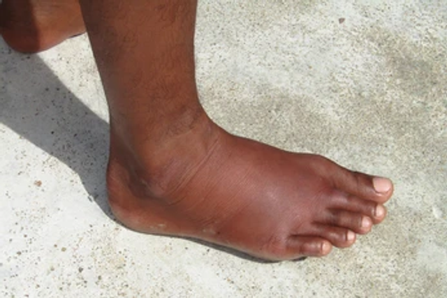 Exercises that reduce leg swelling [shuttershock]