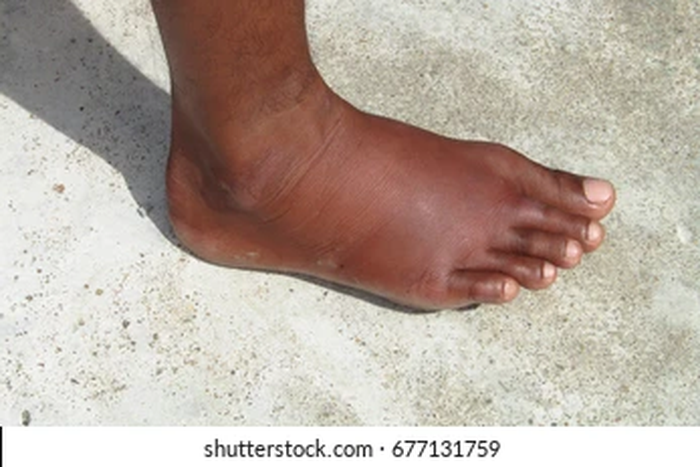 Exercises that reduce leg swelling [shuttershock]