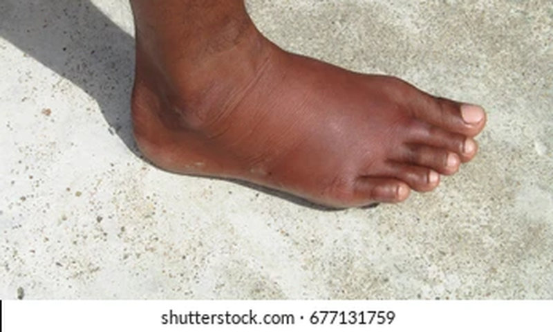 Exercises that reduce leg swelling [shuttershock]