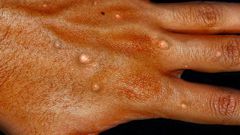 Monkeypox on a hand-Healthdirect