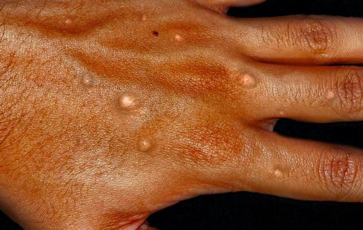 Monkeypox on a hand-Healthdirect
