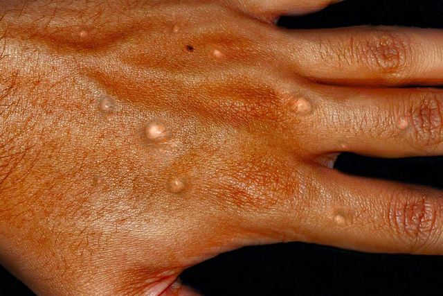Monkeypox on a hand-Healthdirect