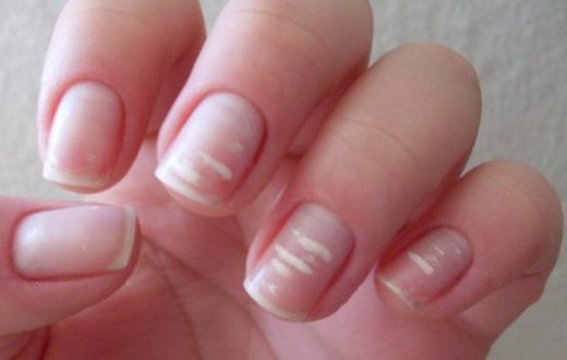 White marks on nails- Marine Healthfoods