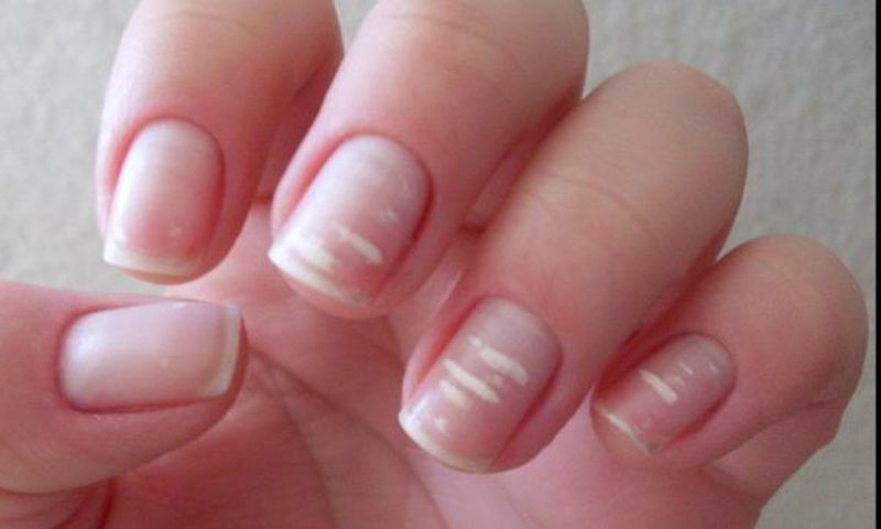 White marks on nails- Marine Healthfoods