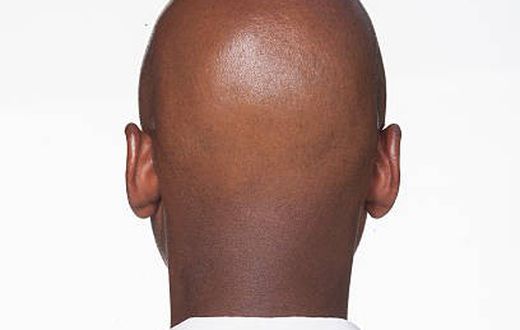 What makes men go bald in their 20s [istockphoto]