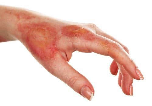 Woman suffers burns while attempting to turn hot water into ice