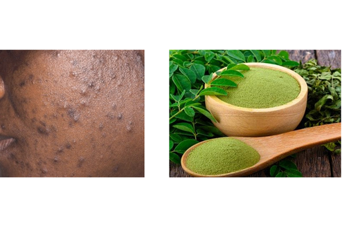 How moringa leaves can clear acne and pimples [datelinehealth/moringaleaves]