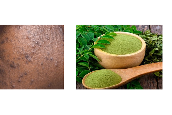 How moringa leaves can clear acne and pimples [datelinehealth/moringaleaves]