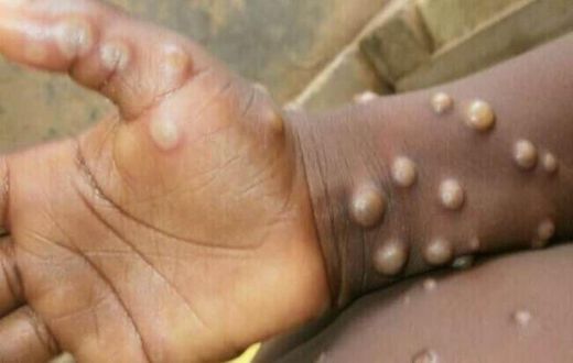 Monkeypox