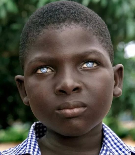 Child with ocular albinism [pinterest]