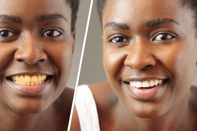 What causes yellow teeth? [Lempies]