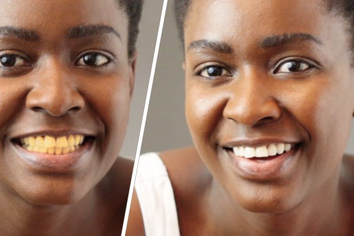 What causes yellow teeth? [Lempies]