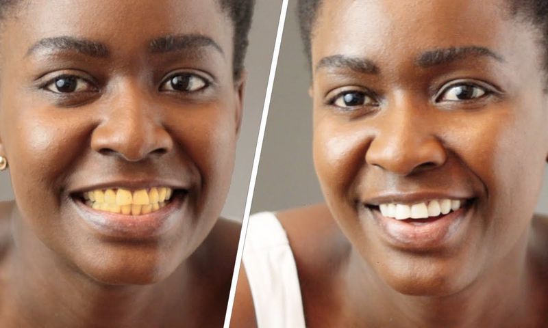 What causes yellow teeth? [Lempies]