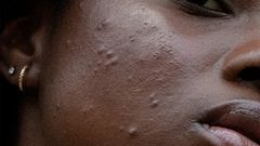 Acne