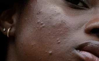 Acne