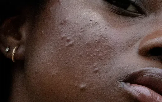 Acne