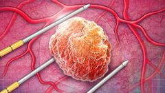 5 signs of prostate cancer you should know