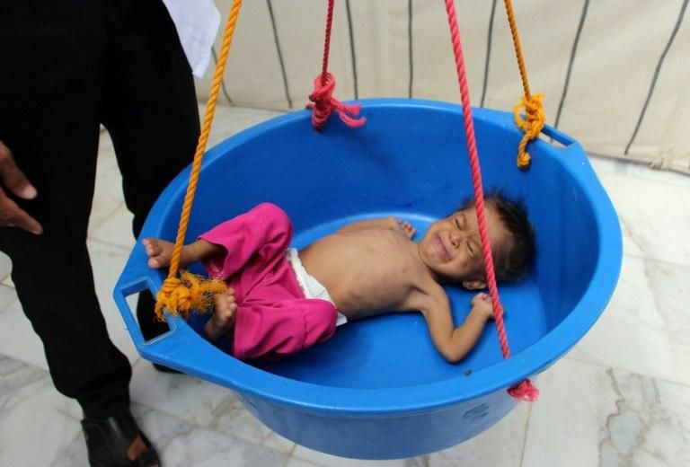 A Yemeni child suffering from severe malnutrition is weighed at a treatment centre in Yemen's northwestern Hajjah province, on November 7, 2018