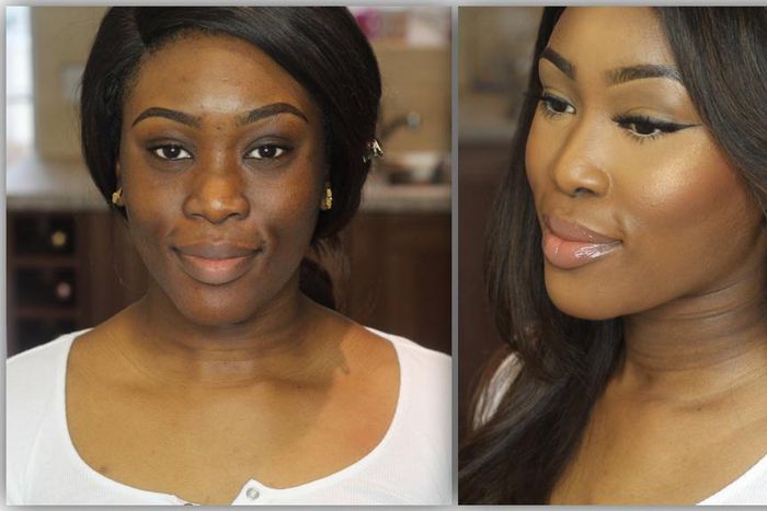 The major cause of hyperpigmentation is Sun exposure.