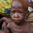 Malnutrition of children under five, worsens — UNICEF