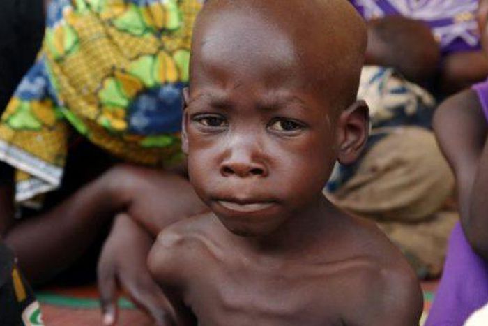 Malnutrition of children under five, worsens — UNICEF