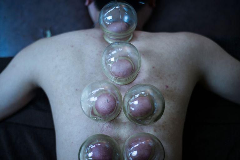 A photo from a cupping therapy session in Hong Kong.