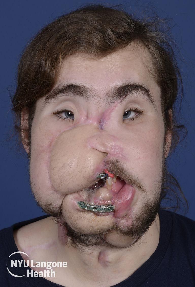 ___9156706___2018___12___1___10___underwood-cameron-front-3-15-17-pre-face-transplant-with-brackets-1543531600