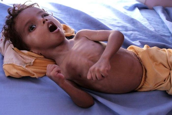 The conflict in Yemen has struggled to garner international attention even as 14 million of its citizens face imminent famine