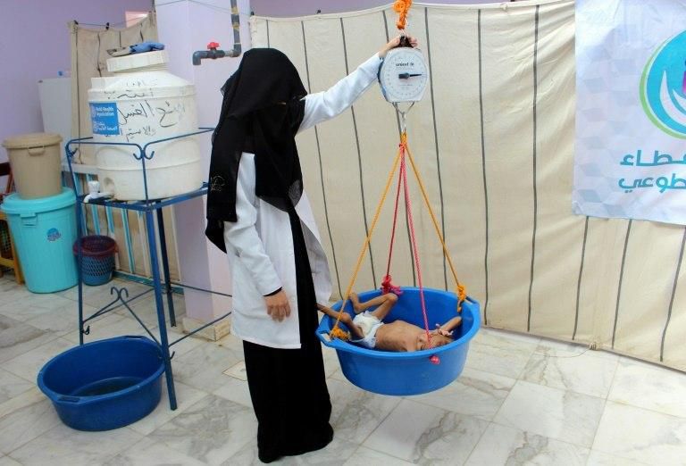 A Yemeni child suffering from severe malnutrition is weighed at a hospital in Yemen's northwestern Hajjah province, on November 7, 2018