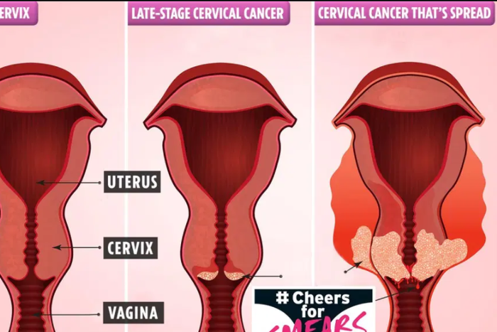 3 ways you can detect cervical cancer early and increase survival rate. [thesun]