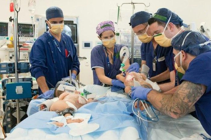 The girls were successfully separated after a six-hour operation at the Royal Children's Hospital in Melbourne