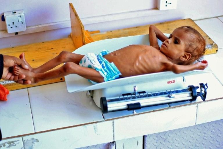A Yemeni child suffering from malnutrition is weighed at a treatment centre in the capital Sanaa on October 6, 2018