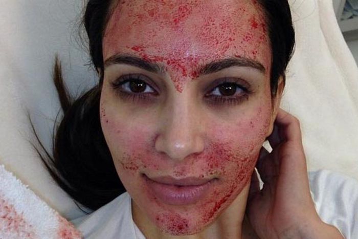 Did you know you can use your own blood for a facial?