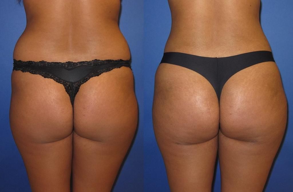 Here are the results of a subtle Brazilian Bum Lift.jpg