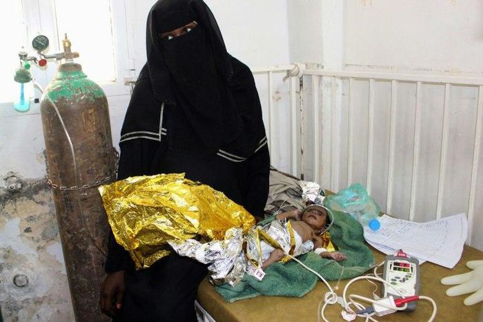 A newborn baby girl suffering from severe malnutrition at a hospital in Yemen's northwestern Hajjah province