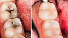 3 home remedies for tooth decay and cavities