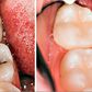 3 home remedies for tooth decay and cavities